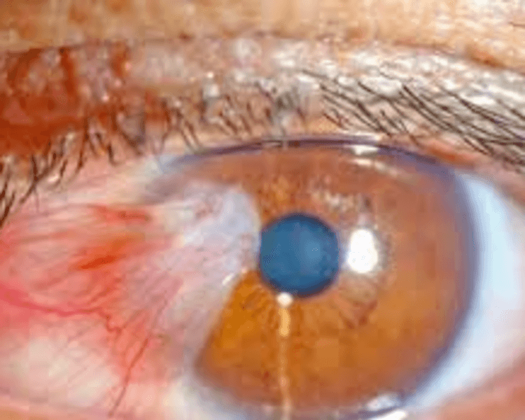 CIRUGIA PTERGION (CARNOSIDAD)