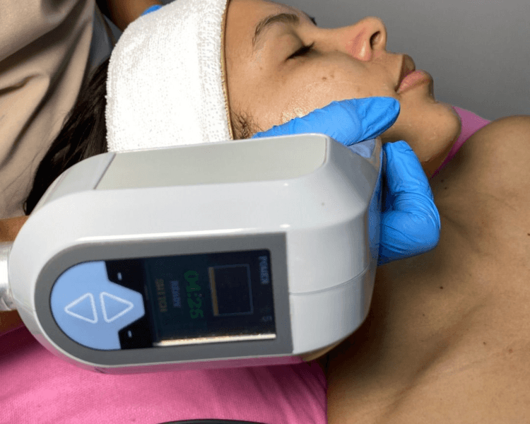 EXILIS FACIAL
