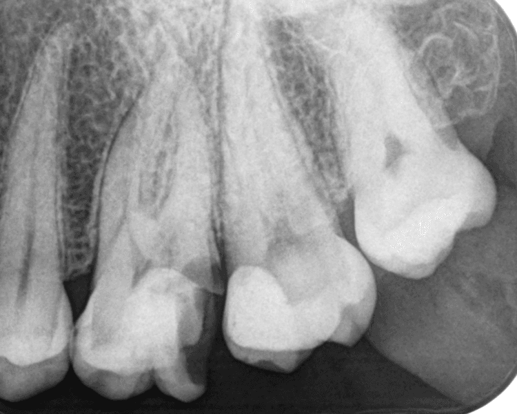 RADIOGRAFIA PERIAPICAL