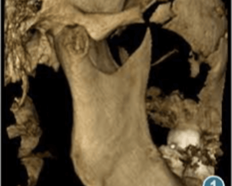 TOMOGRAFIA CBCT ATM BILATERAL