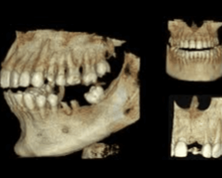 TOMOGRAFIA CONE BEAM MAXILAR COMPLETO