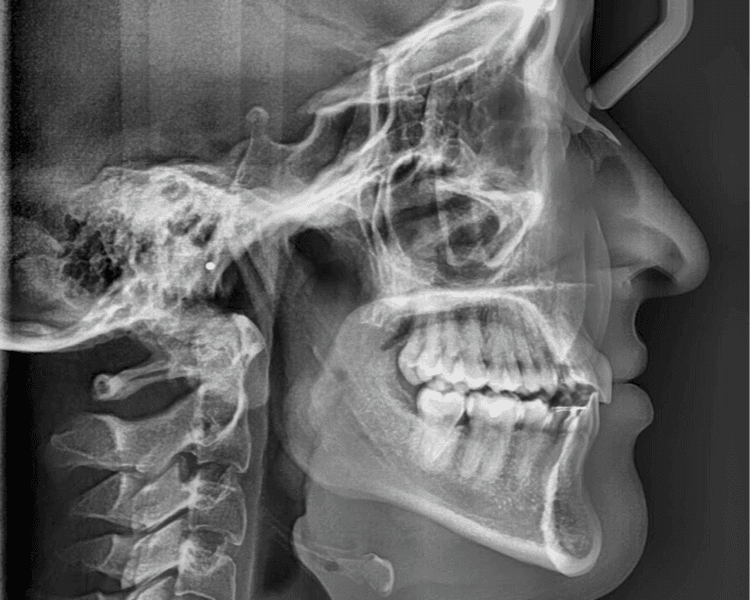 TELERRADIOGRAFIA O RX LATERAL DE CRANEO