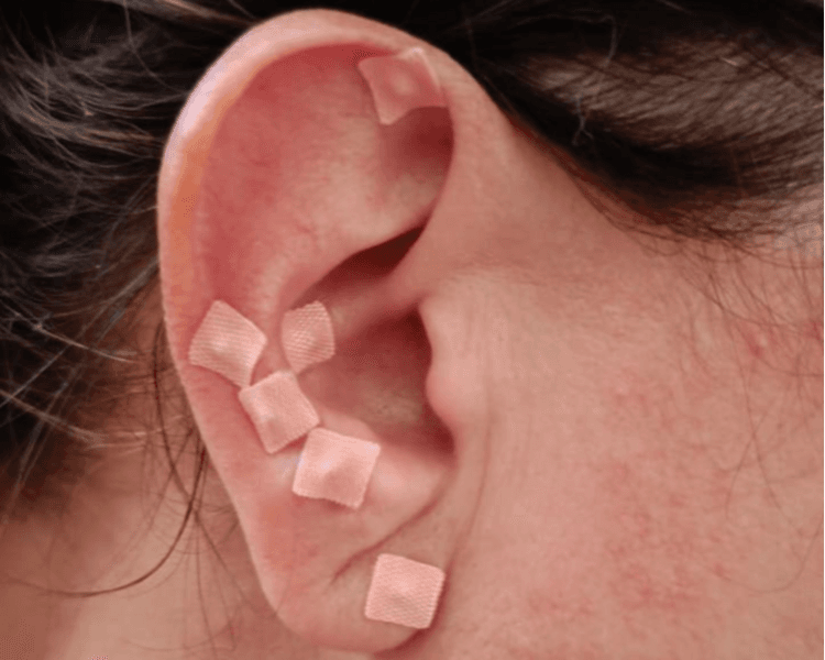 Atención Auriculoterapia