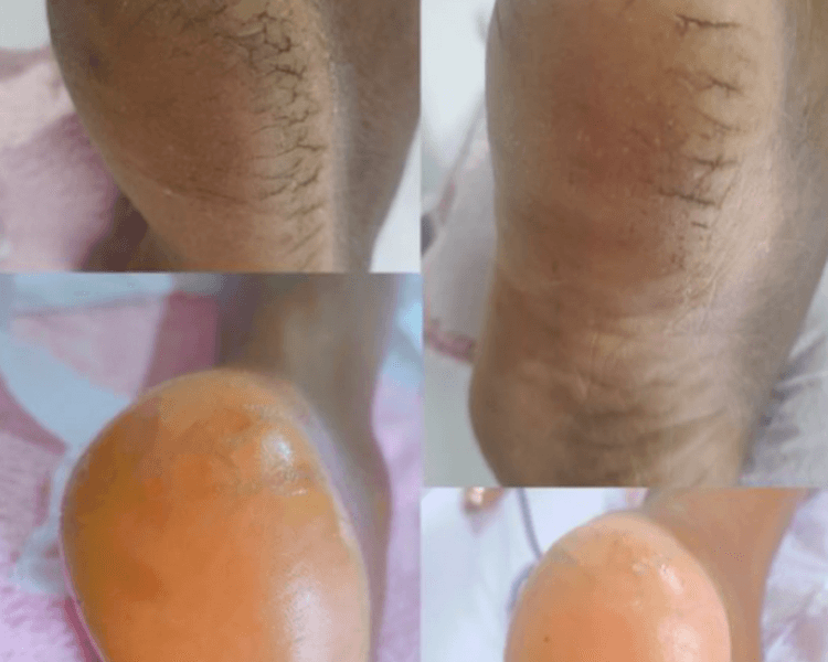 Podologia Estética con Esmaltado semipermanente Opi