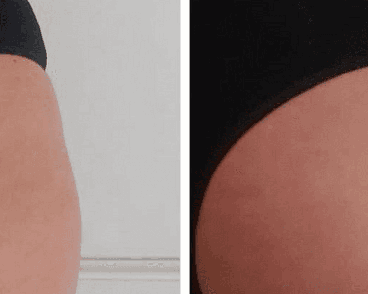 HIFU 12 PRO MAX PIERNAS