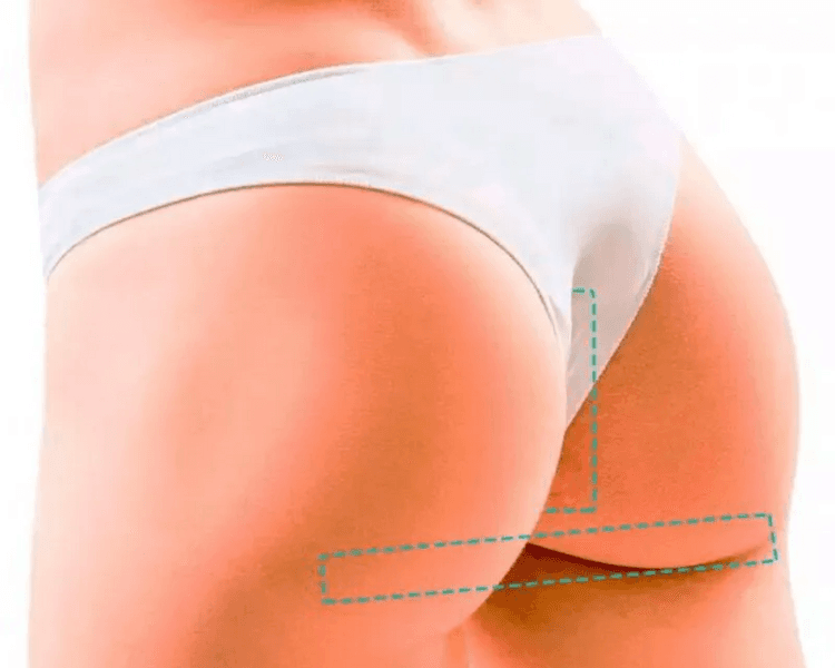 Depilación Intergluteo