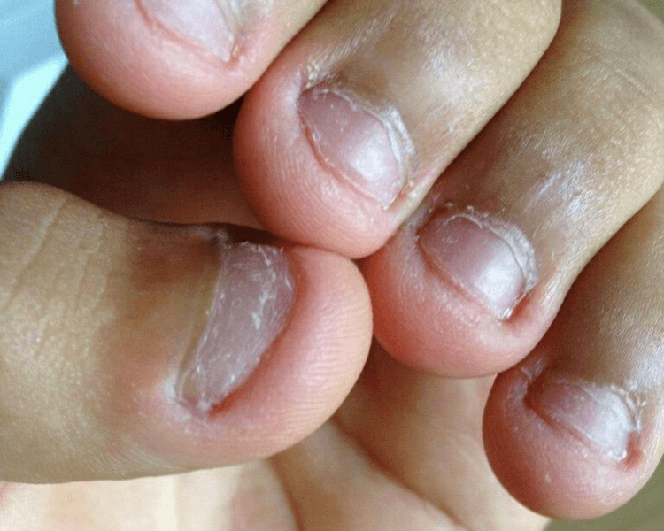 Esculpidas para uñas con ONICOFAGIA