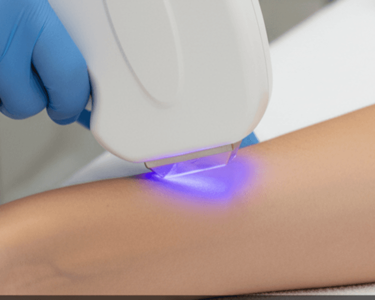 Diodo Antebrazo 1 sesión