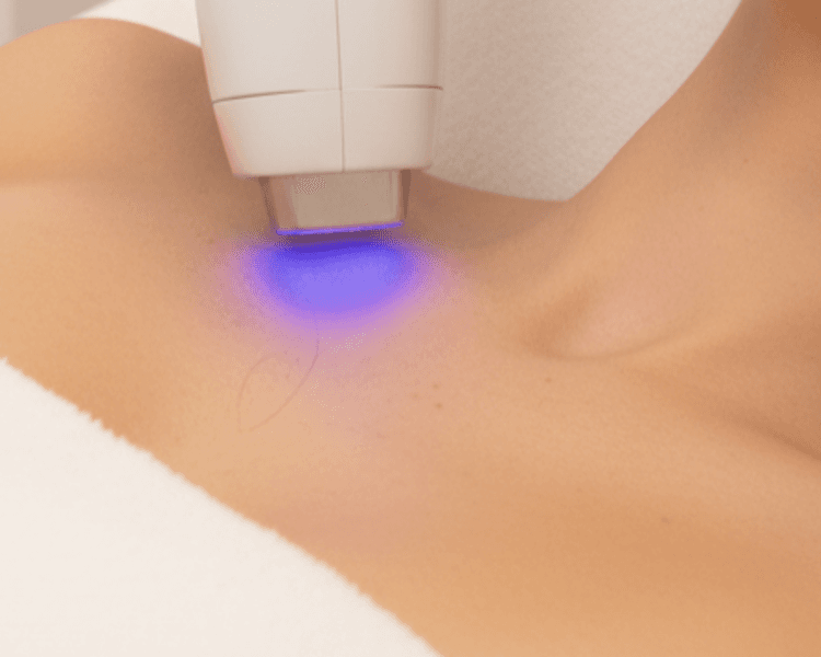 Diodo Busto 1 sesión