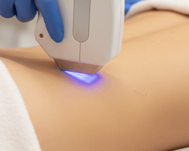 Diodo Coxis 1 sesión