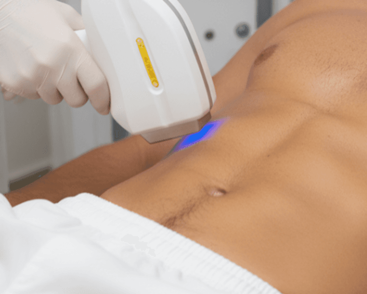 Diodo Abdomen completo 1 sesión