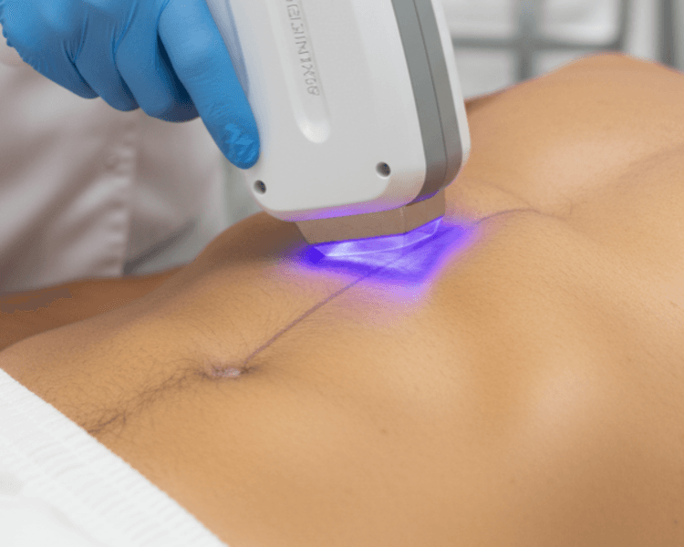 Diodo Linea abdominal 1 sesión