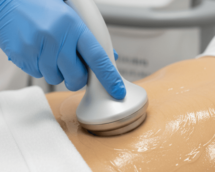 Ultracavitación 10 sesiones