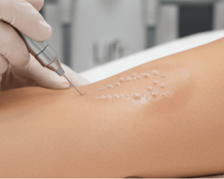 Carbox Brazos 1 sesión