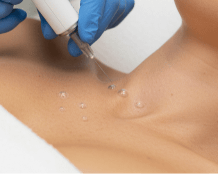 Carbox Zona de escote 1 sesión