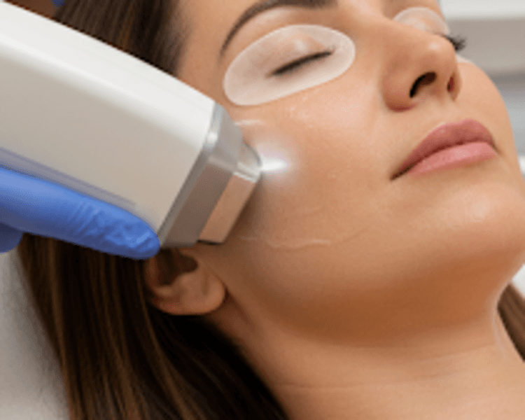 Hifu Rostro Completo 1 sesión