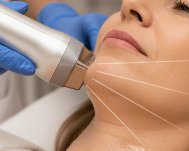 Hifu Papada 1 sesión