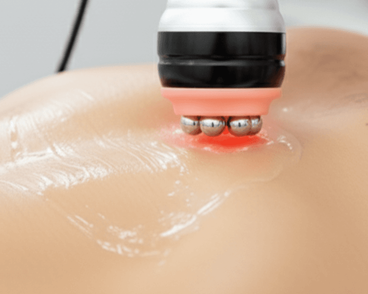 Radiofrecuencia Corporal 1 sesión (por zona)