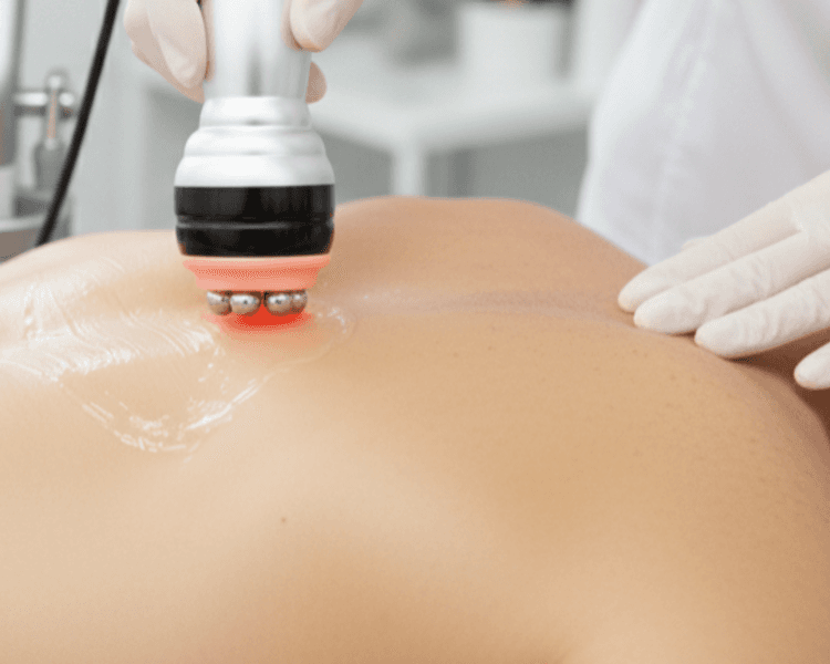 Radiofrecuencia Cuerpo Completo 1 Sesión