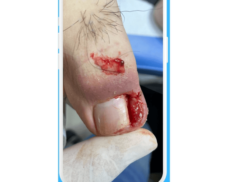 Atención de Onicocriptosis Bilateral