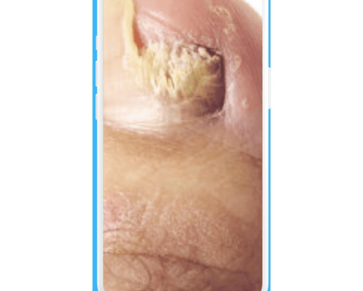 Tratamiento Onicomicosis