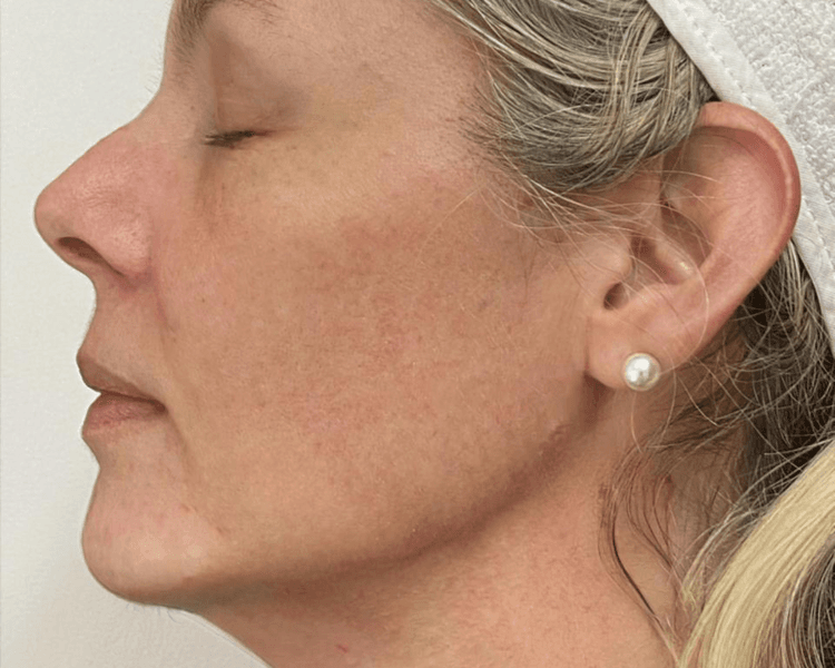 POMULOS-MENTON-ARCO MANDIBULAR