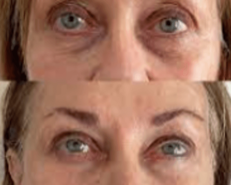 OJERAS PIGMENTARIAS CON SUNEKOS