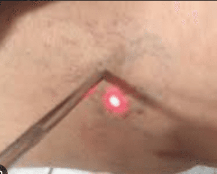 VARICES LASER