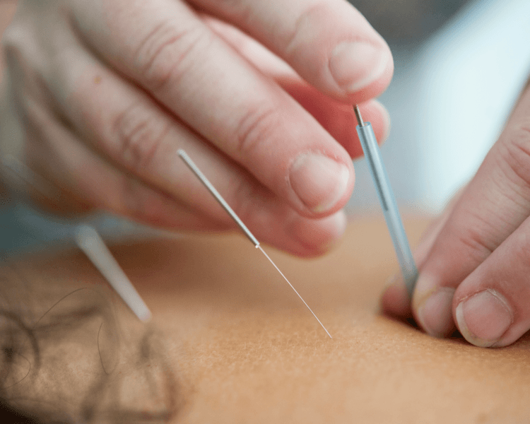 Acupuntura