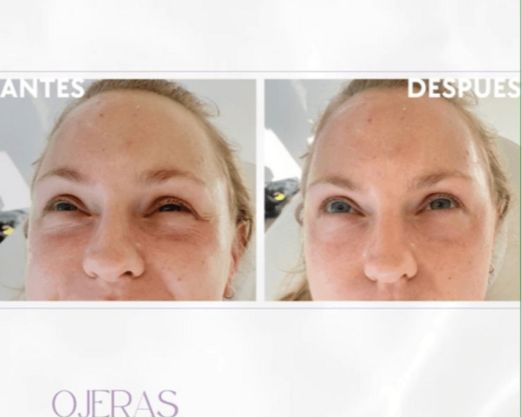 PROMO REJUVENECE MIRADA: TOXINA BOTULINICA+ OJERAS