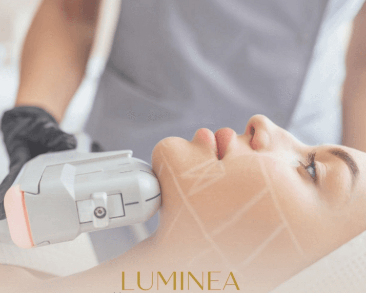 RF MICRONEEDLING + ACTIVOS - Rostro completo