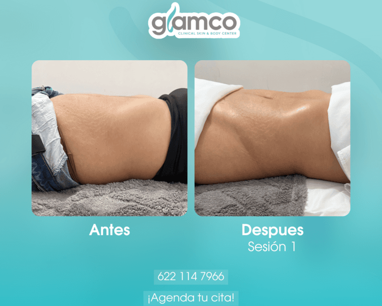 Lipo Drenaje Brasileño