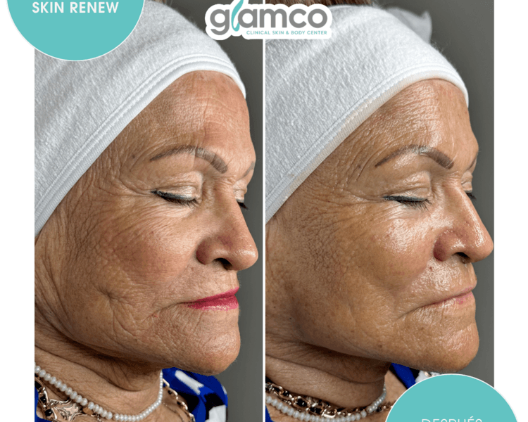 Facial de Rejuvenecimiento Instantaneo