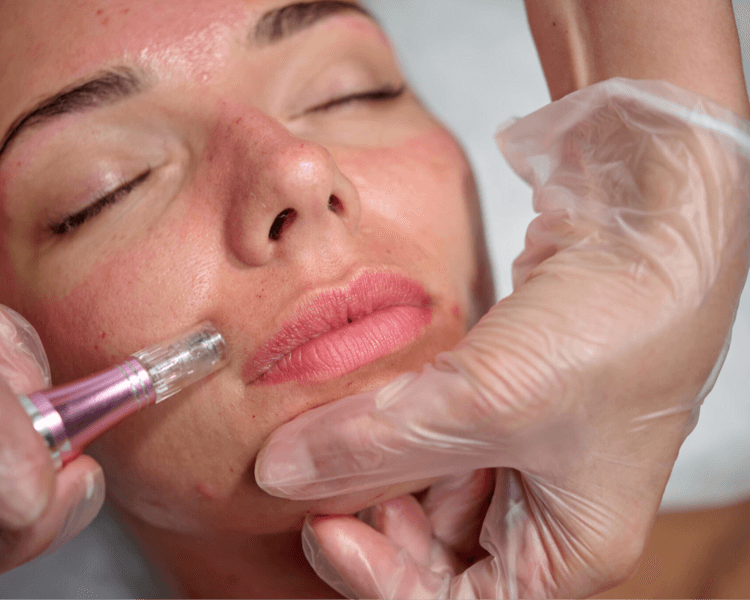 Dermapen - Microneedling Facial