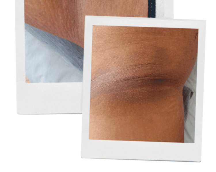 Blanqueamiento con láser picosecond