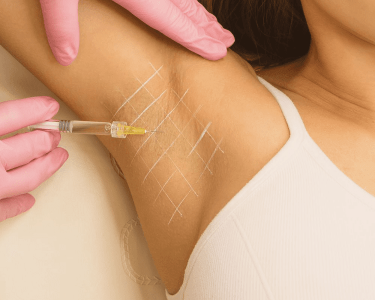 Hiperhidrosis (Toxina Botulinica)