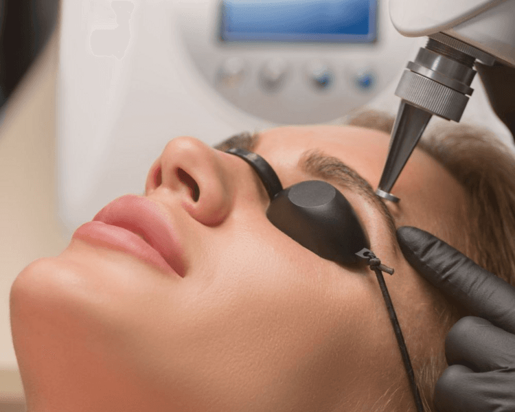 Remocion de microblading