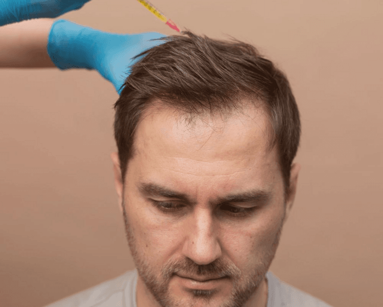 Plasma Rico en Plaquetas Capilar