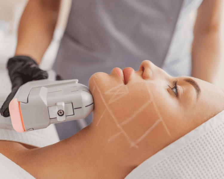 HIFU (Rostro, Cuello y Escote)