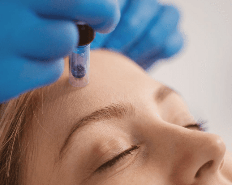 Microneedling + Skinmark