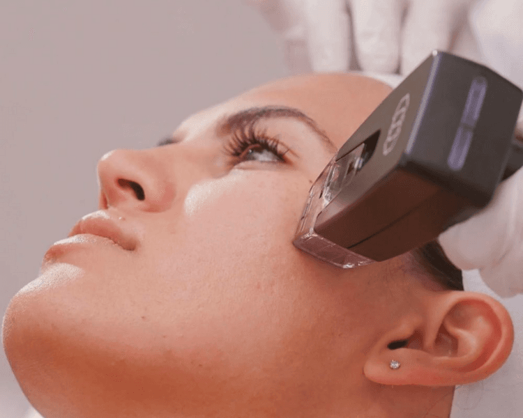 Radiofrecuencia Fraccionada Microagujas Facial (Morpheus)