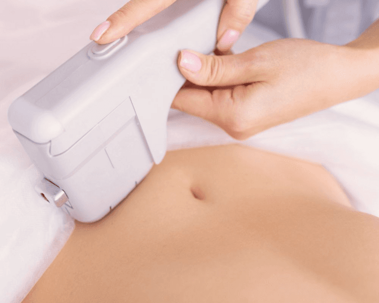 Radiofrecuencia Fraccionada Microagujas Corporal (Morpheus)