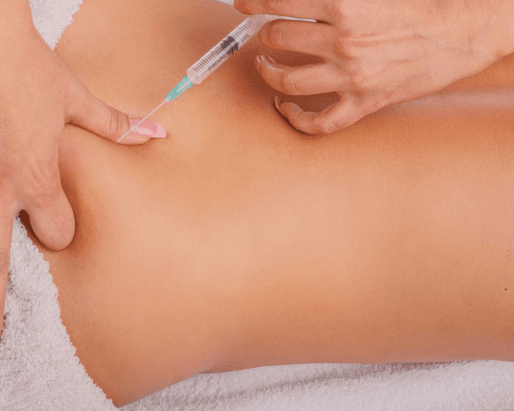 Mesoterapia Corporal (reductora/ anticelulitica/ tensora) ESCENCIAL