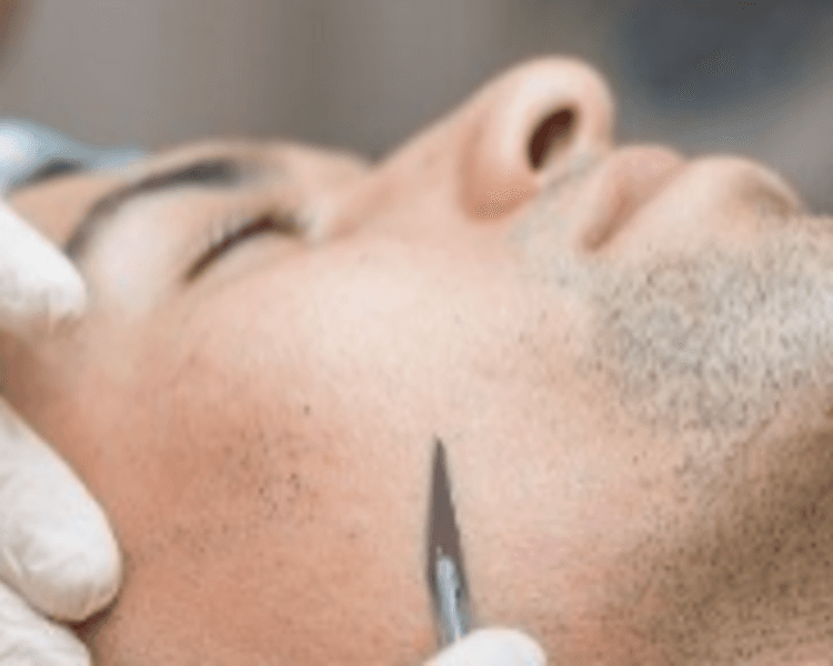 RITUAL PELING QUIMICO O DERMAPLANING