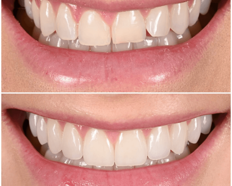 🟢🟢🟢MICRODISEÑO DE SONRISA incluye GUARDA DE BRUXISMO