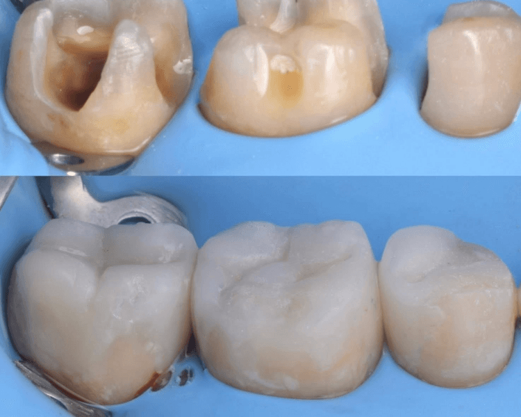 RESINA POR DIENTES $$$$ DE $850 A $1500 SEGUN LA PROFUNDIDAD