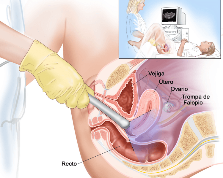 Ultrasonido transvaginal