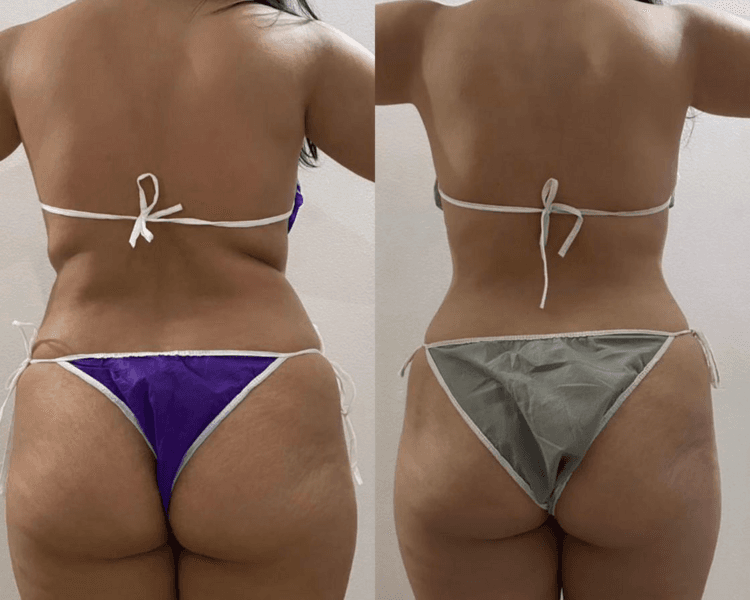 PAQUETE CUERPO COMPLETO 10 SESIONES