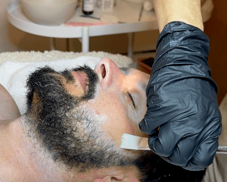 Higiene Facial Profunda con Microneedling