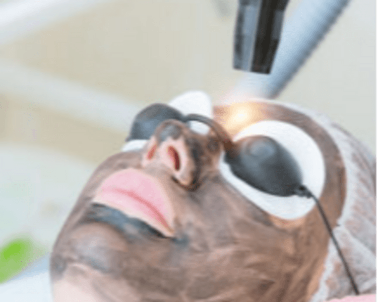 Hollywood Peel + Limpieza Facial Profunda